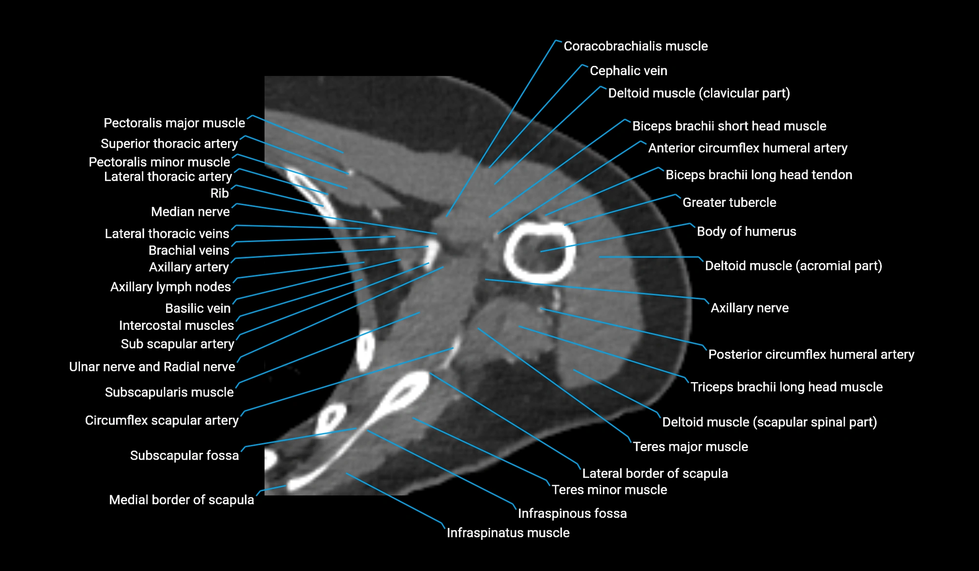 CT upper arm axial  cross sectional anatomy labelled radiology image -00126.webp